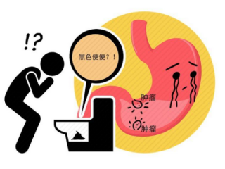早期胃癌的隐形信号，超90%患者忽视的两大症状